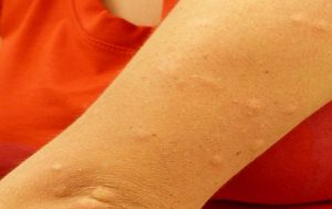 muggenbeten behandelen dan jeuk en vlekken