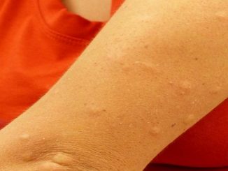 komary gryzie niż leczy swędzenie i plamy