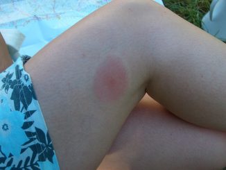 muggenbeet zwelling en roodheid wat te doen