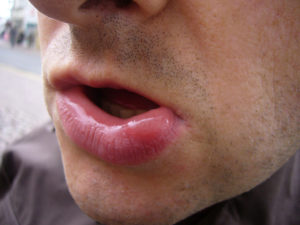 what to do if a wasp has bitten on the lip