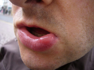 Τι πρέπει να κάνετε αν μια σφήκα έχει δαγκώσει στο χείλος