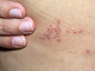 how to treat bug bites on the human body