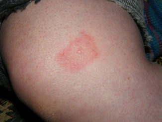 tick bite symptoms of borreliosis