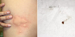 bedbugs on a person symptoms